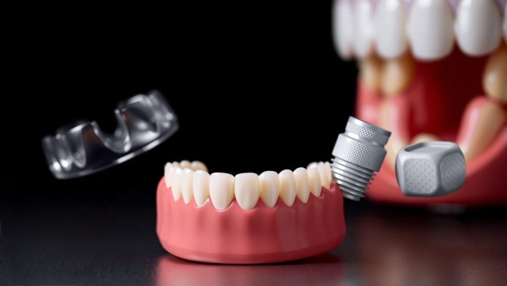 This image shows various dental applications of zirconia, including crowns, bridges, and implant components, highlighting its aesthetic qualities and structural performance in oral environments.