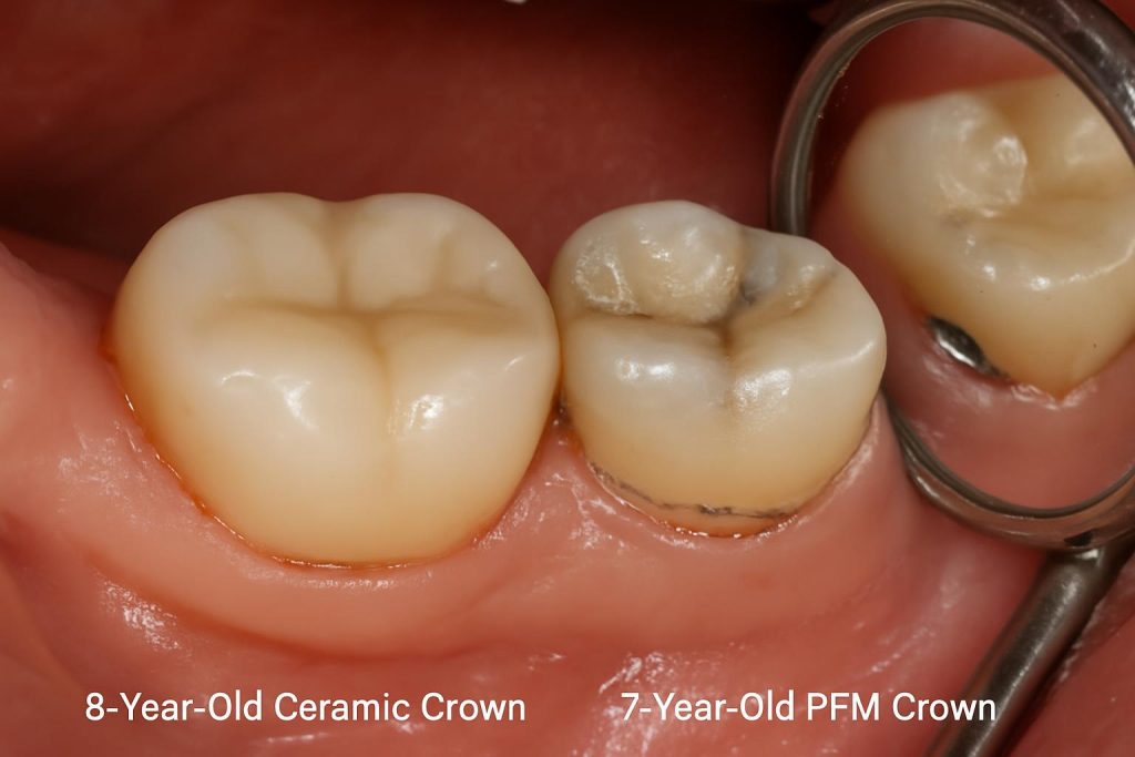 Long-term clinical comparison of zirconia vs. PFM restorations Clinical comparison of 8-year-old zirconia crown next to a 7-year-old PFM crown showing wear patterns and margin integrity